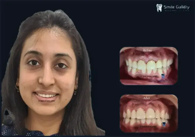 Smile case 9: before and after photos, shared with the patient’s consent