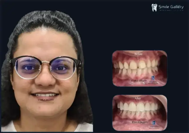 Smile case 1: before and after photos, shared with the patient’s consent