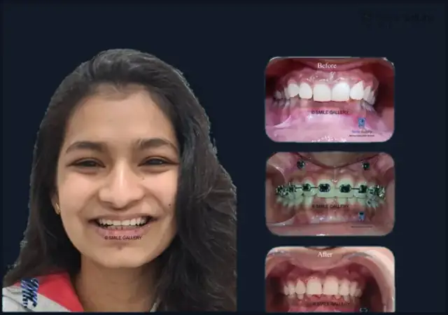 Smile case 2: before and after photos, shared with the patient’s consent
