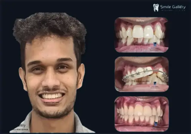 Smile case 3: before and after photos, shared with the patient’s consent