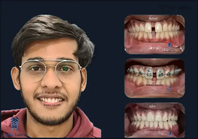 Smile case 4: before and after photos, shared with the patient’s consent