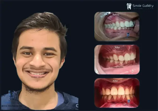 Smile case 5: before and after photos, shared with the patient’s consent