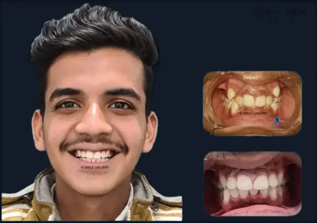 Smile case 6: before and after photos, shared with the patient’s consent