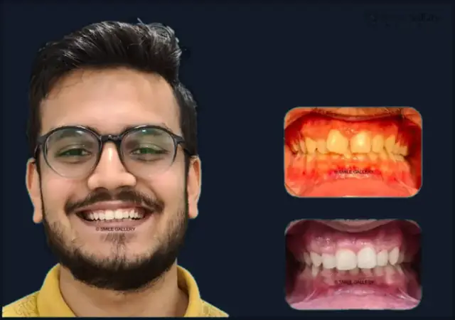 Smile case 8: before and after photos, shared with the patient’s consent