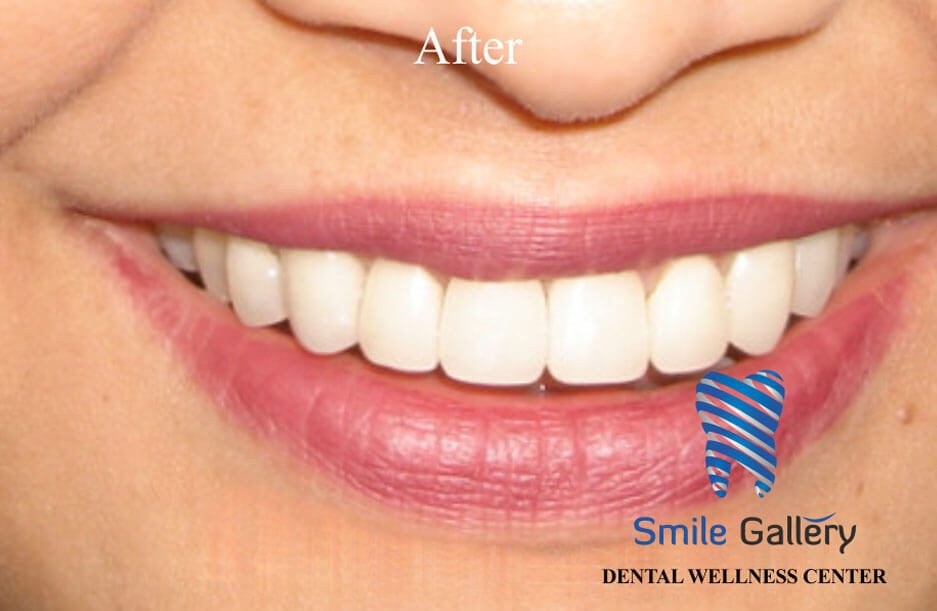 After smile makeover: aligned, uniform front teeth