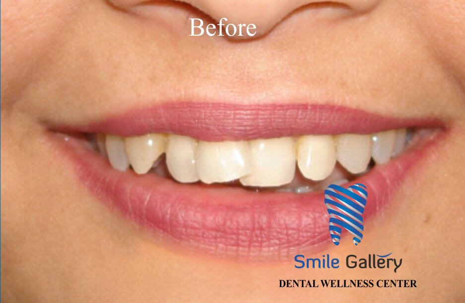 Before smile makeover: uneven, gapped front teeth