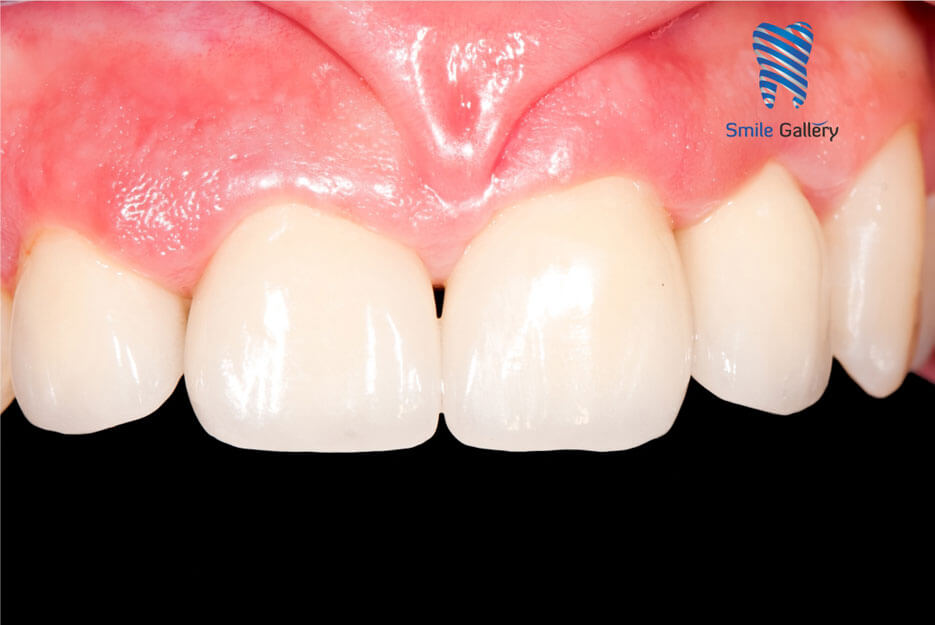After: dental crown restoration completed