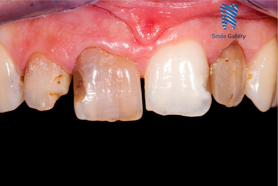 Before: damaged tooth requiring a crown