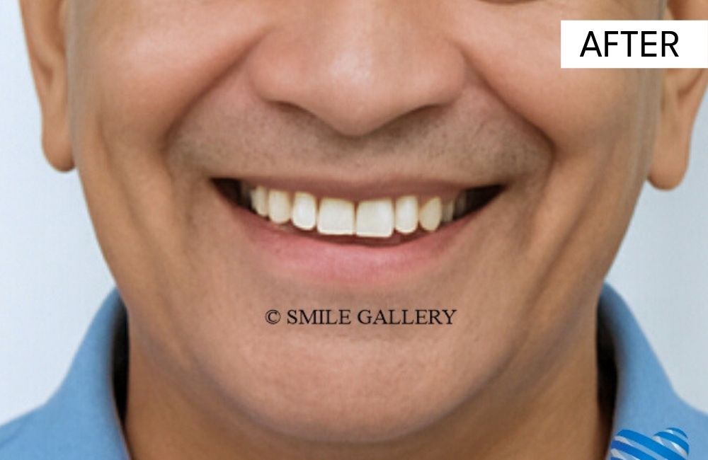 After: full mouth rehabilitation, case 2