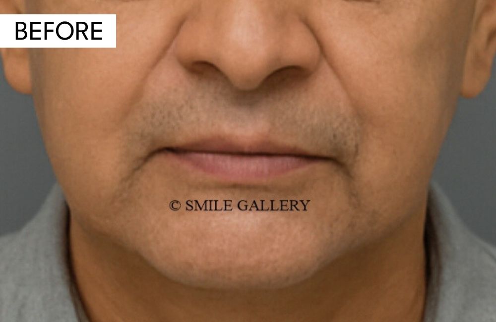 Before: full mouth rehabilitation, case 2