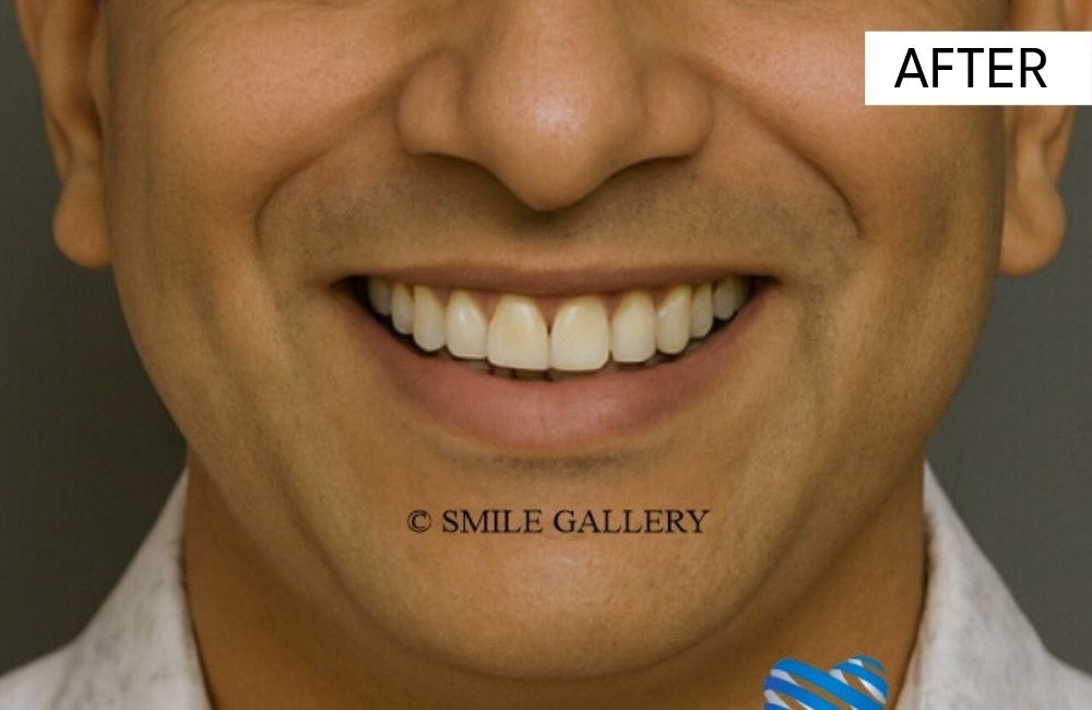 After: full mouth rehabilitation, case 3