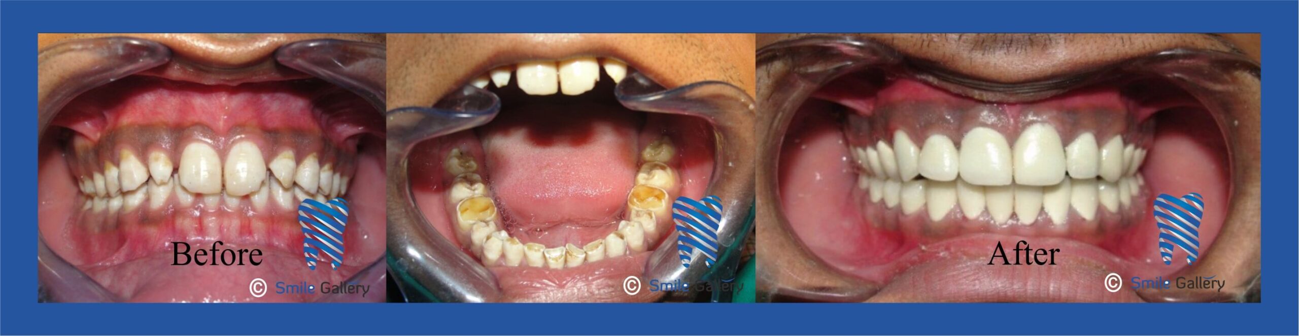 Overview image illustrating full mouth rehabilitation treatment