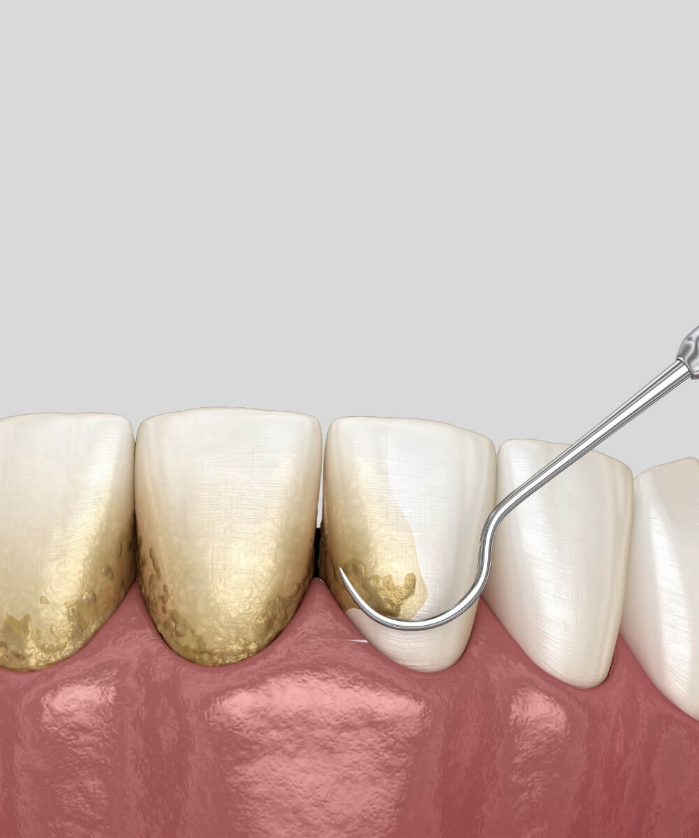 Teeth Cleaning in Bhopal at Smile Gallery Dental Wellness Centre