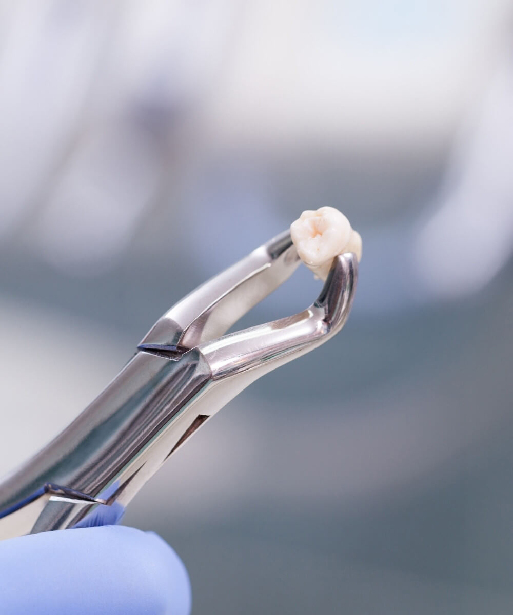Wisdom Tooth Removal in Bhopal at Smile Gallery Dental Wellness Centre
