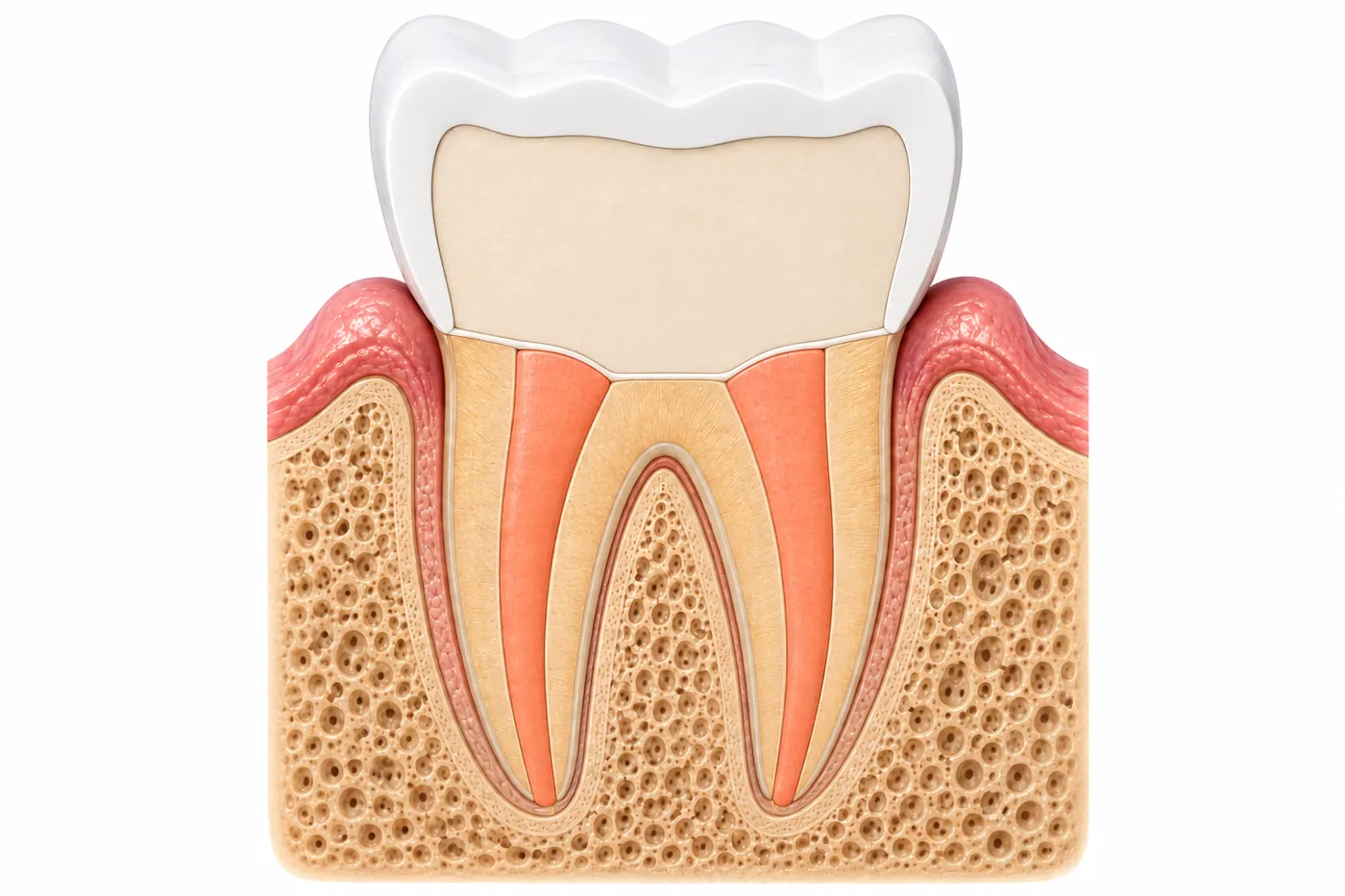 The same tooth fully treated: canals sealed with filling material, a ceramic crown on top, and healed bone at the root tip.