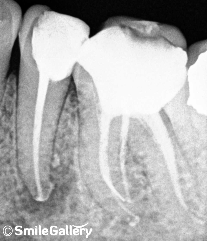 After: X-ray of completed root canal with filled canals and restoration