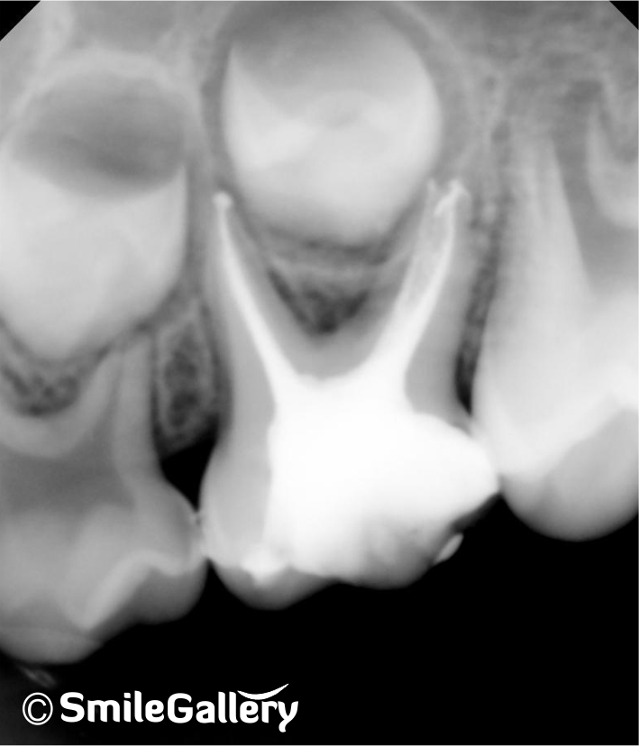 After: X-ray of completed root canal with filled canals and restoration