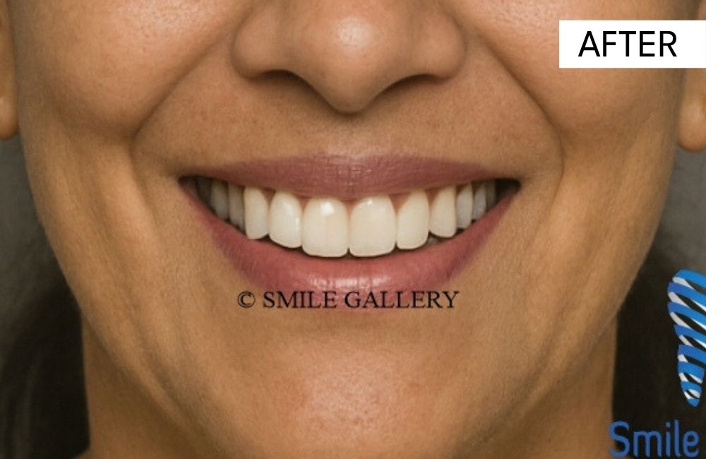 After: porcelain veneers restoration completed