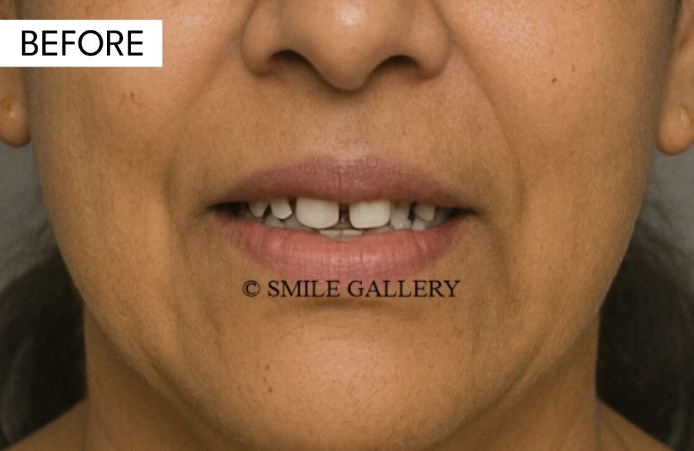 Before: chipped, gapped, or stained front teeth