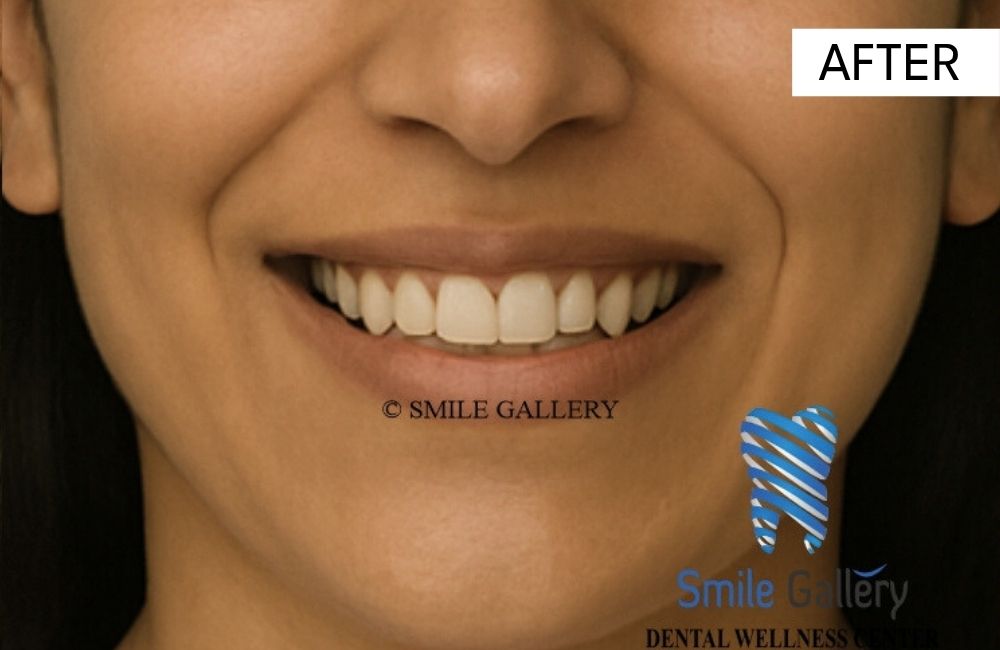 After: porcelain veneers restoration completed