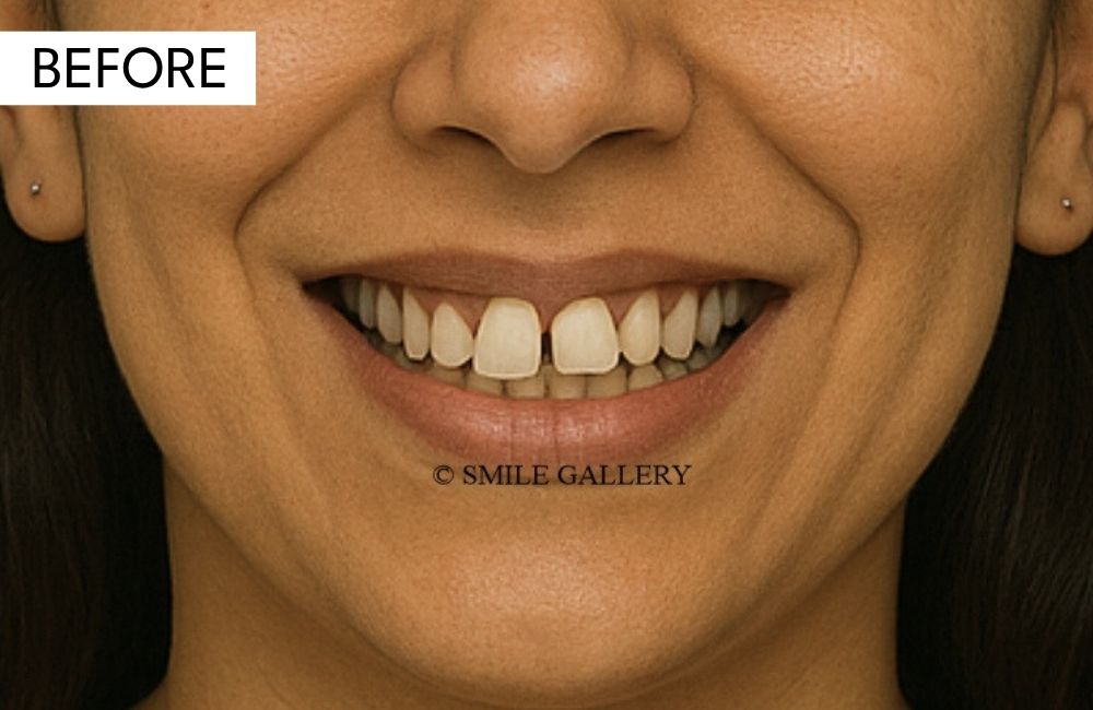 Before: chipped, gapped, or stained front teeth