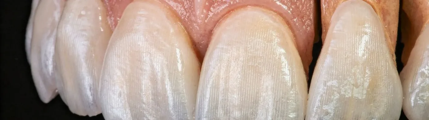 Close-up macro view of the natural, tooth-like translucency of a finished porcelain veneer