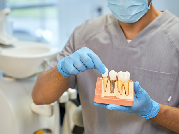 5 Things to Consider Before Getting Dental Implants