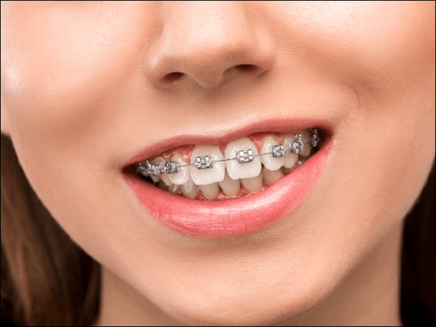 metal braces