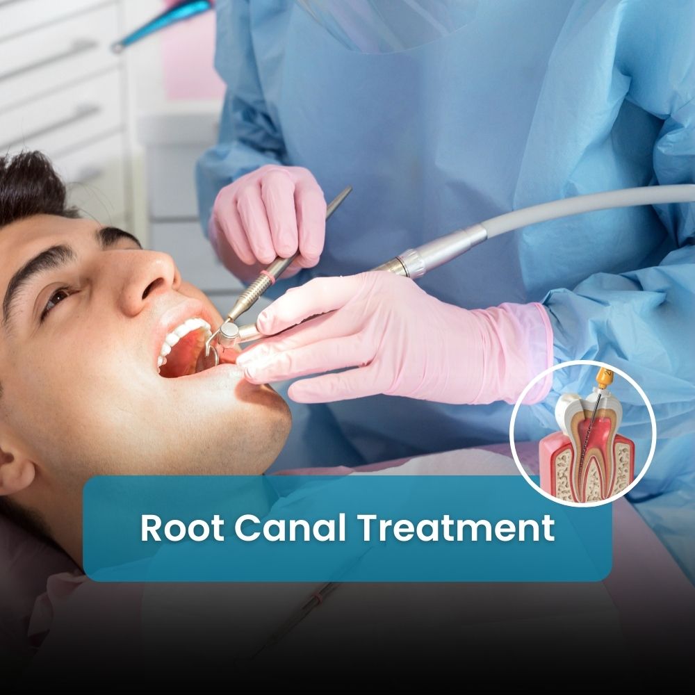 root canal