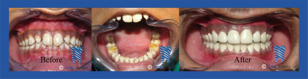 smile-gallery-Fullmouth Rehab
