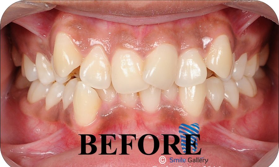 smile-gallery-Orthodontics Before After 3a