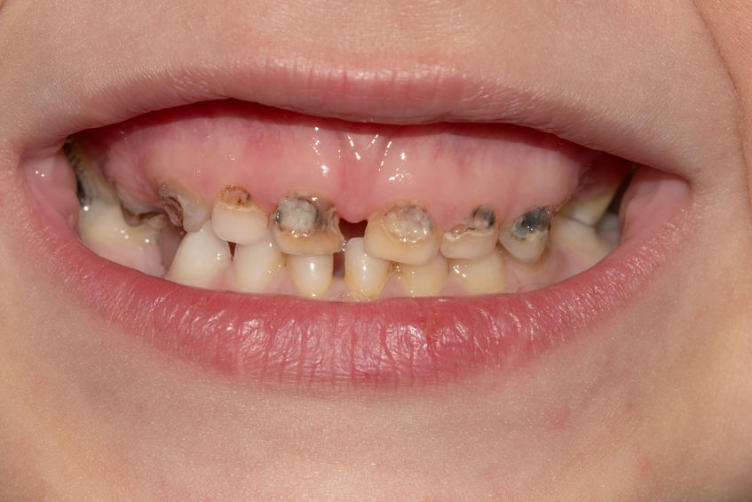 smile-gallery-children Dentistry (1)