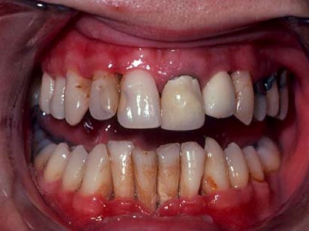 Smoking Is Responsible for Tooth Decay 