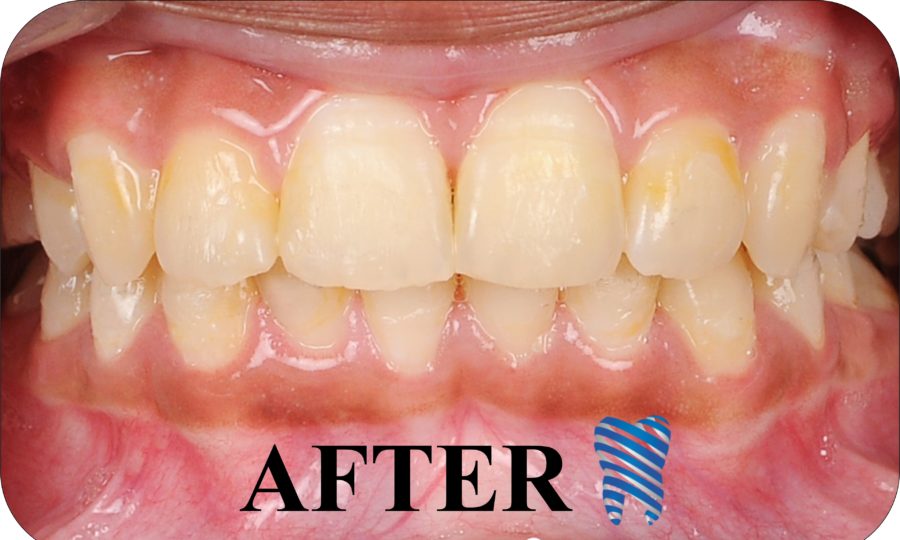 Orthodontics Before After