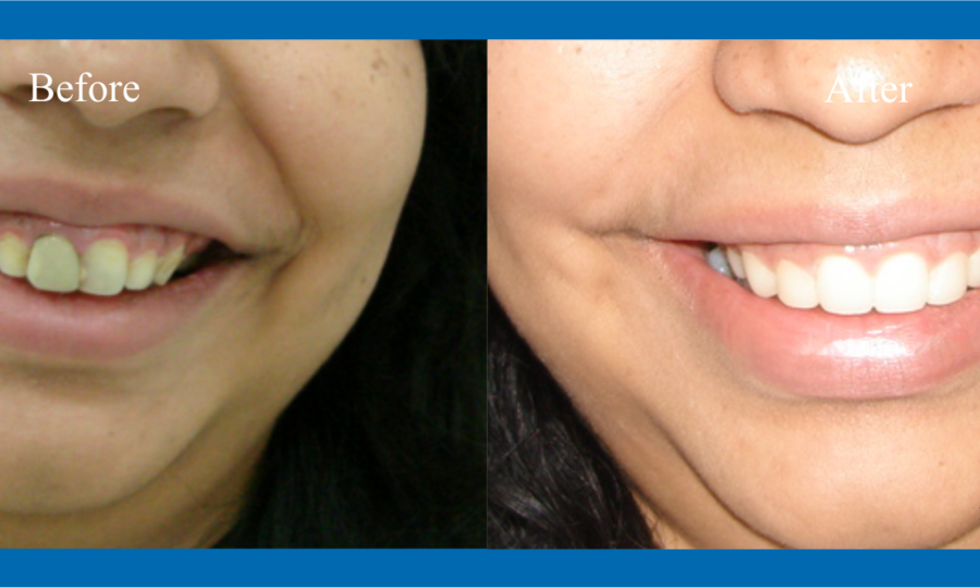 Wisdom tooth Removal in Bhopal, smile-gallery-Smile DSD2