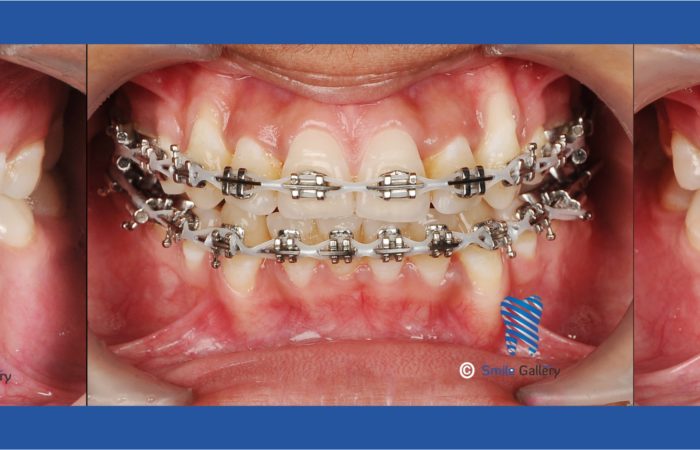 Braces: The Orthodontic Treatment in Bhopal