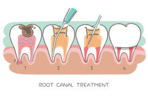 Stages of root canal treatment