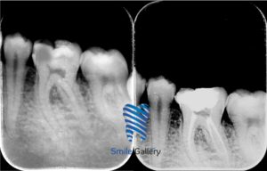 Root Canal Xray pic