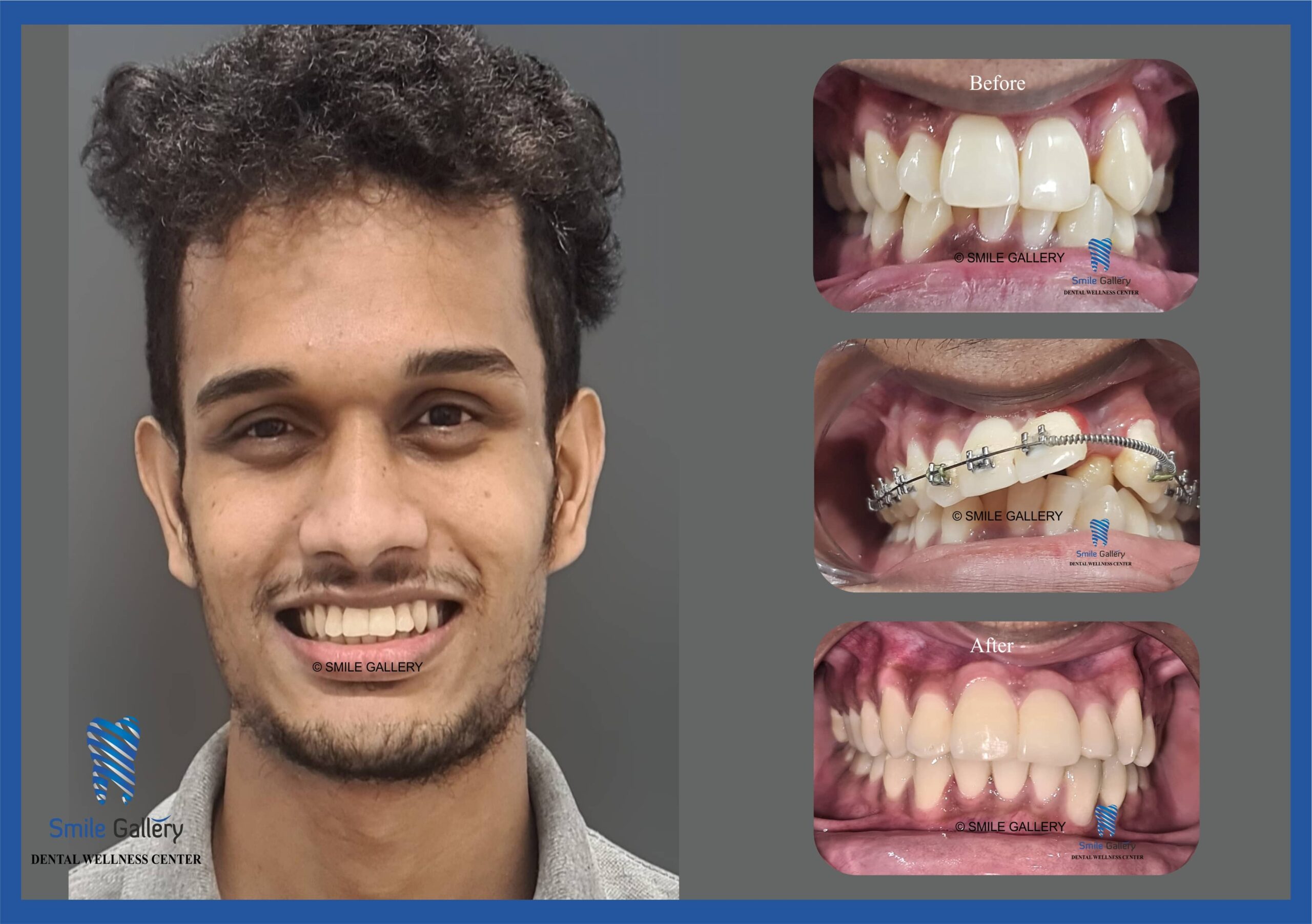 Smile Treatment Gallery