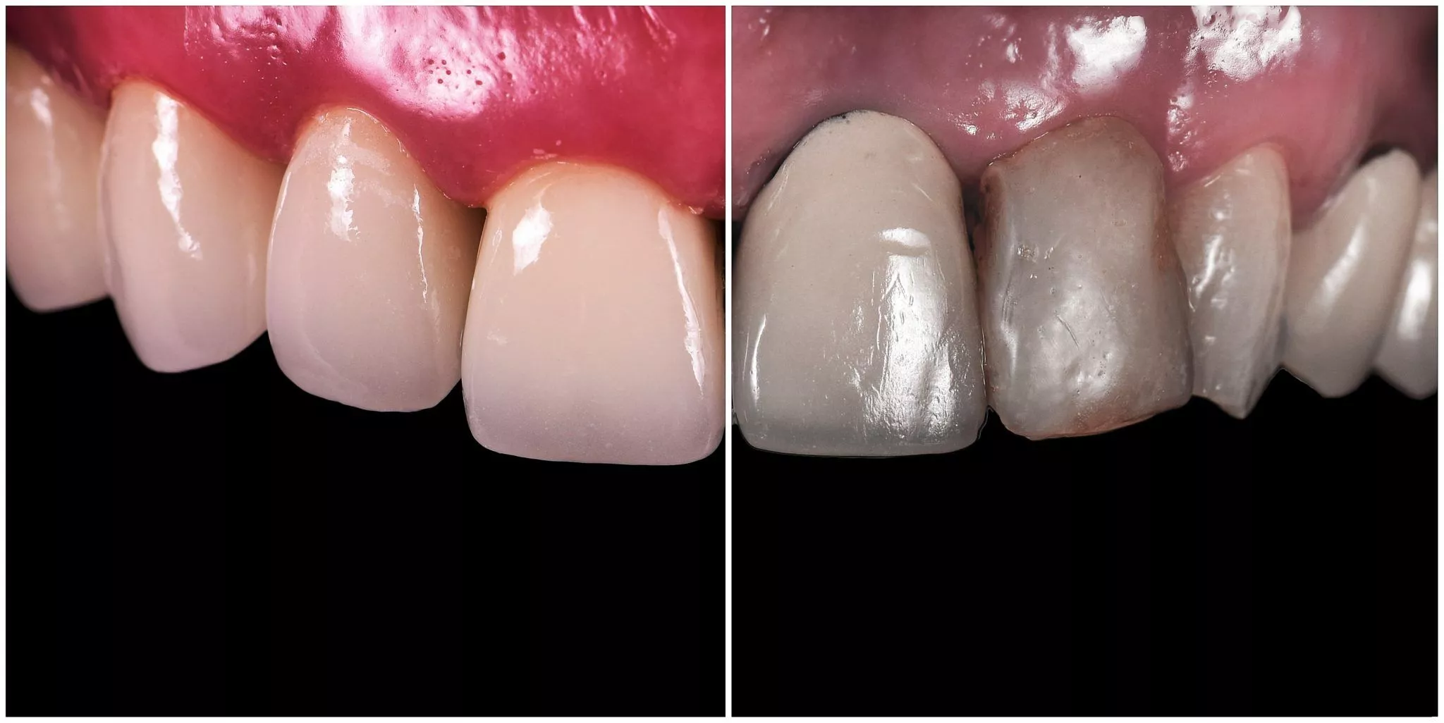 Close-up, side-by-side photo of front teeth showing a clear difference in shade and shape between two smiles