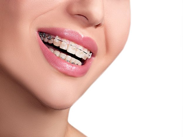 Why Are Invisible Braces the First Option for Teenagers?