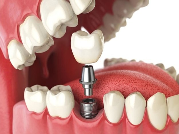 Fix a Loose Tooth Permanently with Dental Implants