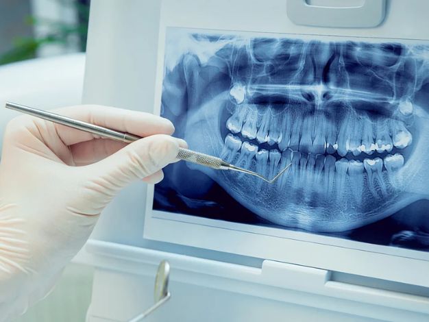 The Role of Dental Xray in Dental Treatment?