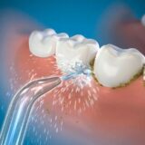 Water Flossers -Beneficial or Harmful after Teeth Cleaning