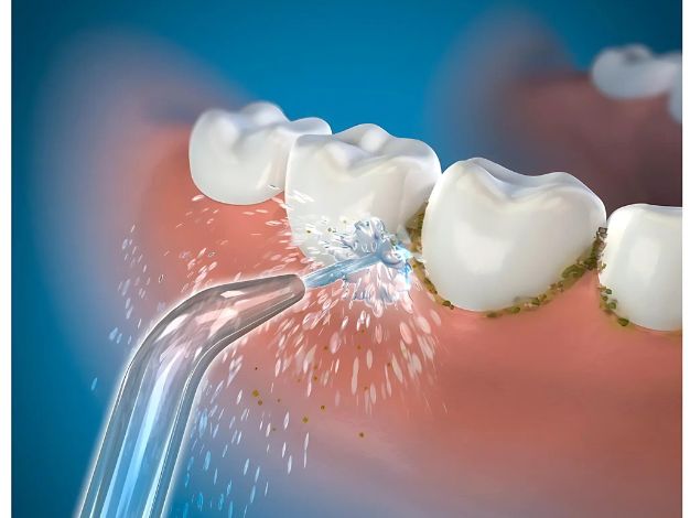 Water Flossers: Beneficial or Harmful after Teeth Cleaning