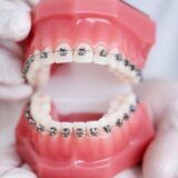 braces treatment