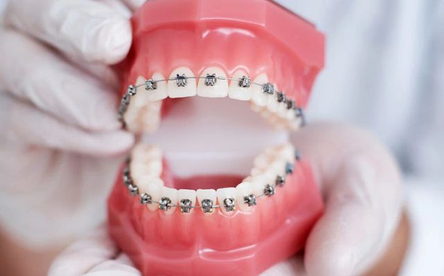 Best Braces Specialist in Bhopal