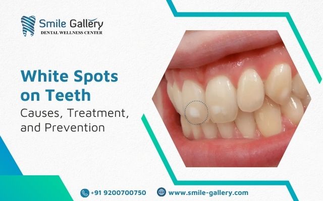 White Spots on Teeth – Causes, Treatment, and Prevention