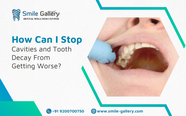 How Can I Stop Cavities and Tooth Decay From Getting Worse