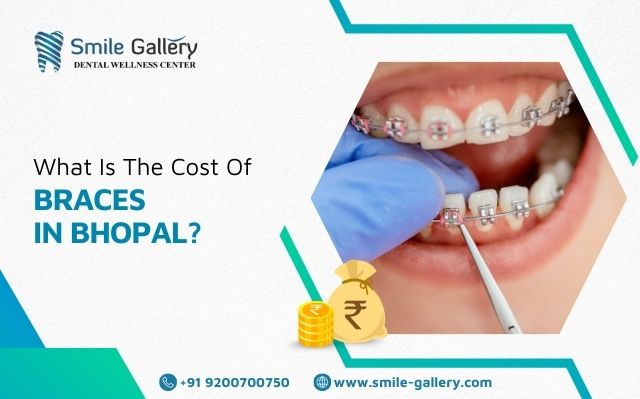 What is the cost of braces in Bhopal?